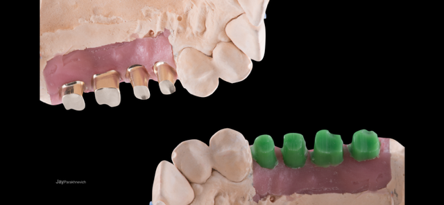 Implant Restoration